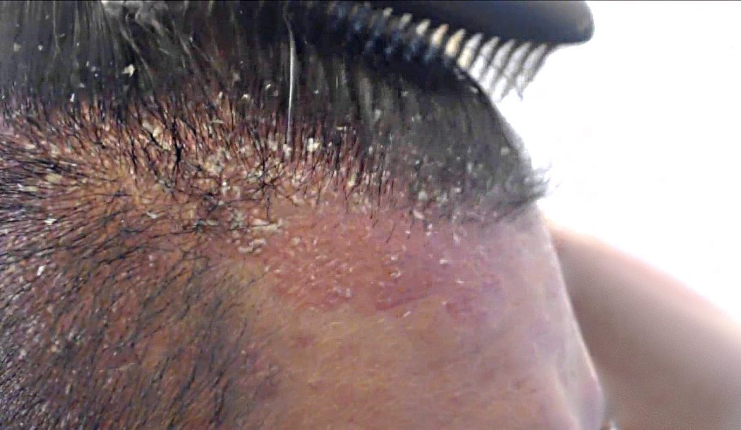 Come curare la Dermatite Seborroica