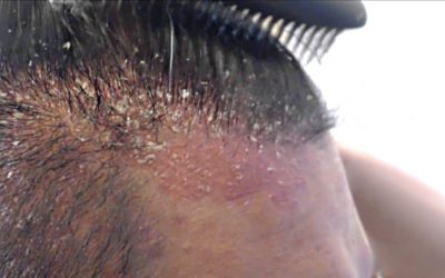 Come curare la Dermatite Seborroica