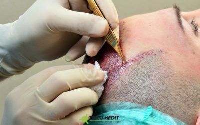 Quale tecnica di autotrapianto dei capelli? Le differenti tecniche di prelievo dei follicoli piliferi