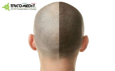Tricopigmentazione pro e contro