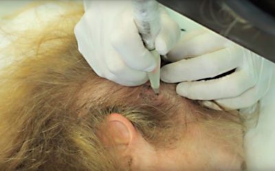 Tricopigmentazione capelli nella donna