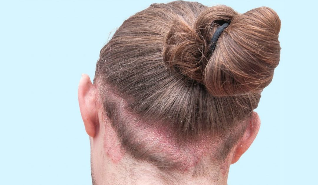 Psoriasi cuoio capelluto