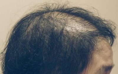 Cura per l’alopecia androgenetica femminile
