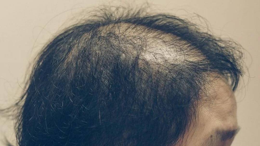 alopecia androgenetica femminile