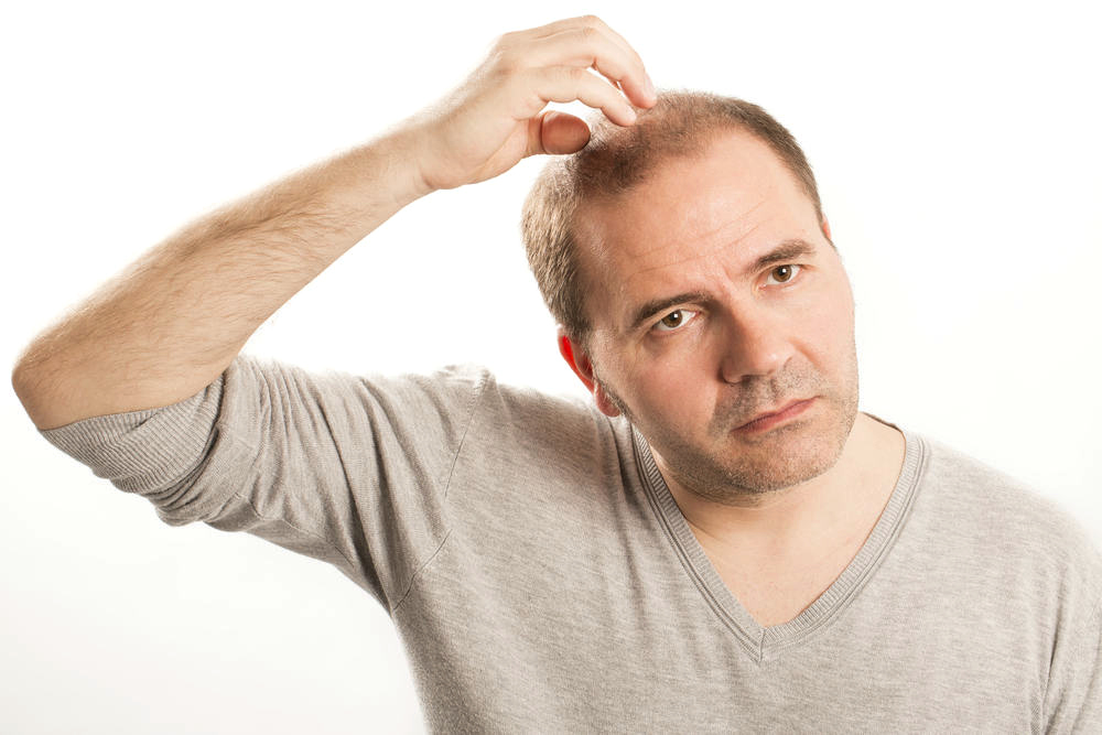 Cura alopecia androgenetica maschile