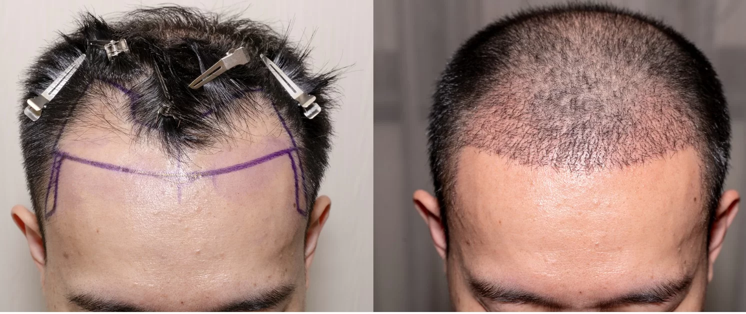trapianto capelli funziona