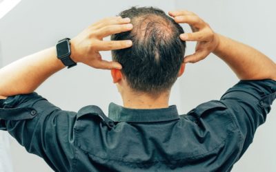 Calvizie cause e soluzioni