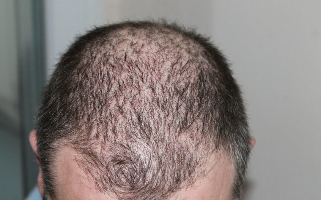 alopecia androgenetica: come riconoscerla e come curarla