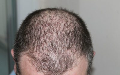 Alopecia androgenetica: come riconoscerla e come curarla