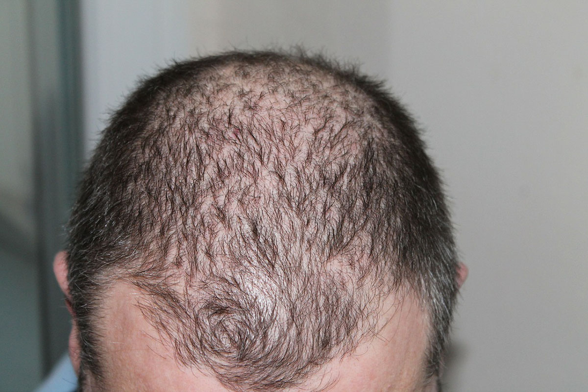 alopecia androgenetica: come riconoscerla e come curarla