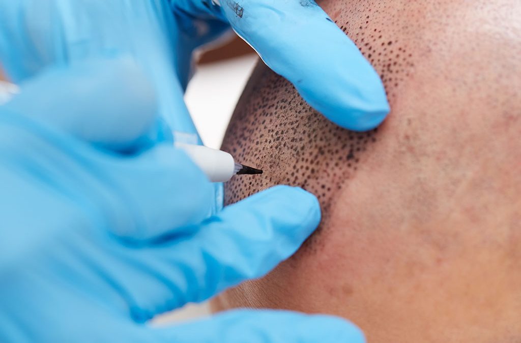 Tricopigmentazione: soluzione immediata al diradamento dei capelli