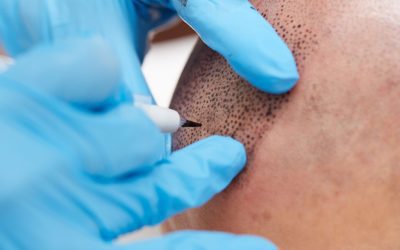 Tricopigmentazione: soluzione immediata al diradamento dei capelli