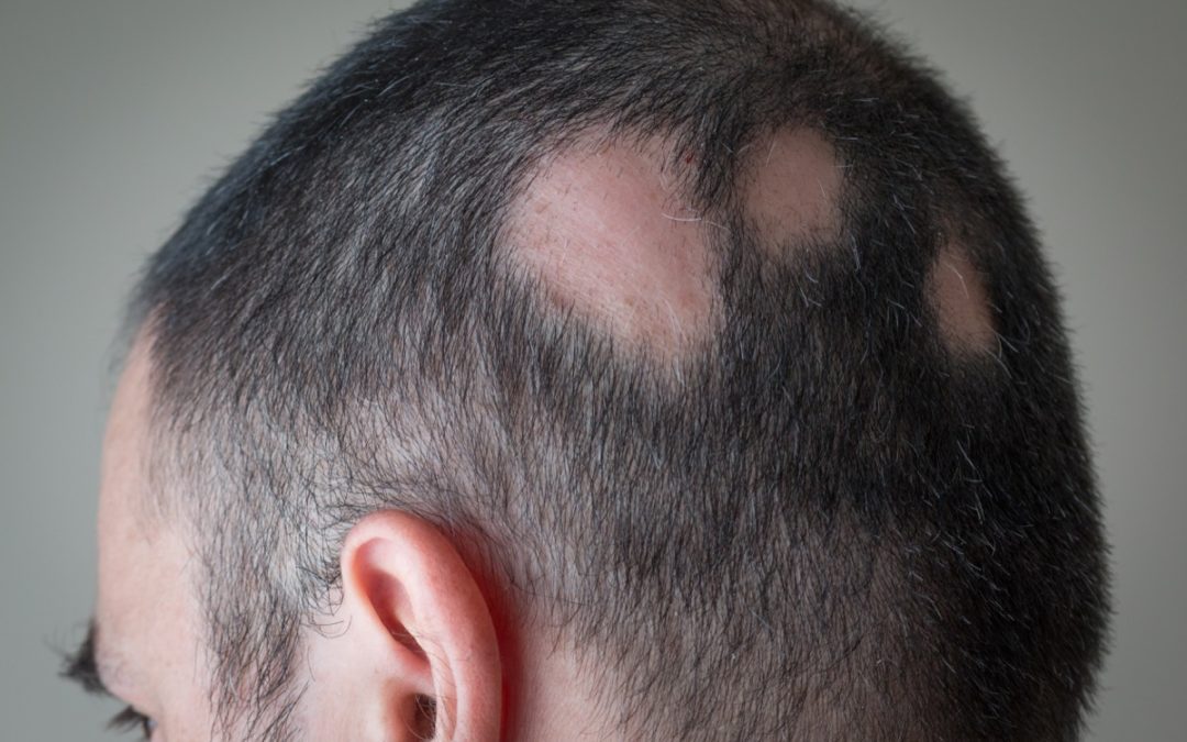 Alopecia Areata: perché cadono i capelli a chiazze e cosa fare