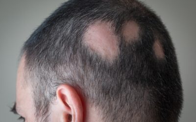 Alopecia areata: cause e cure