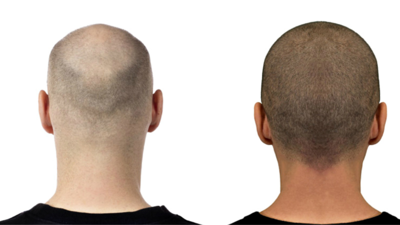 Tricopigmentazione Tricomedit
