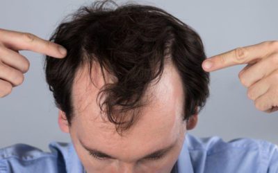 Perdita dei capelli: cosa fare