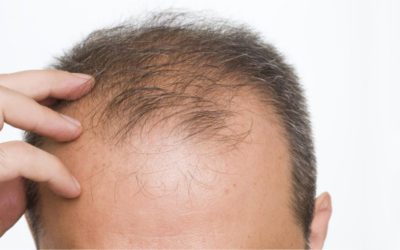 Diradamento dei capelli: le principali cause