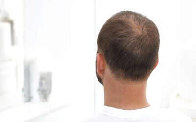 Alopecia Seborroica cause e rimedi