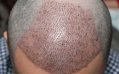 Come avviene il trapianto capelli