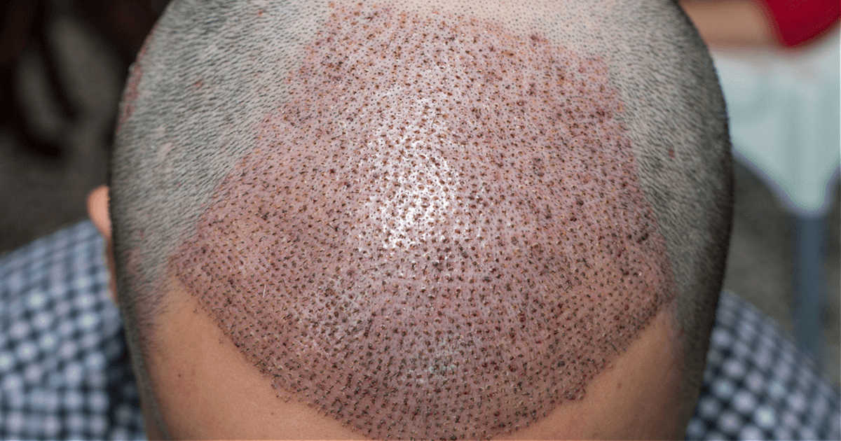 trapianto dei capelli come soluzione alla calvizie