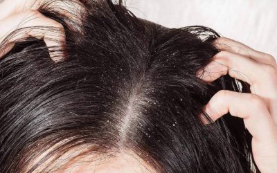 Seborrea o ipersecrezione sebacea del cuoio capelluto