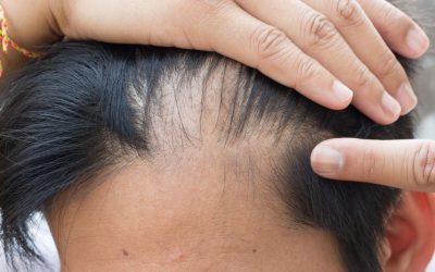 Sintomi Alopecia androgenetica