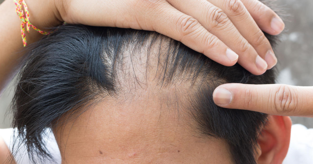 Sintomi alopecia androgenetica