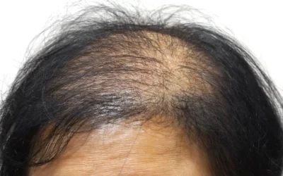 Il diradamento capelli donne: cause e cure