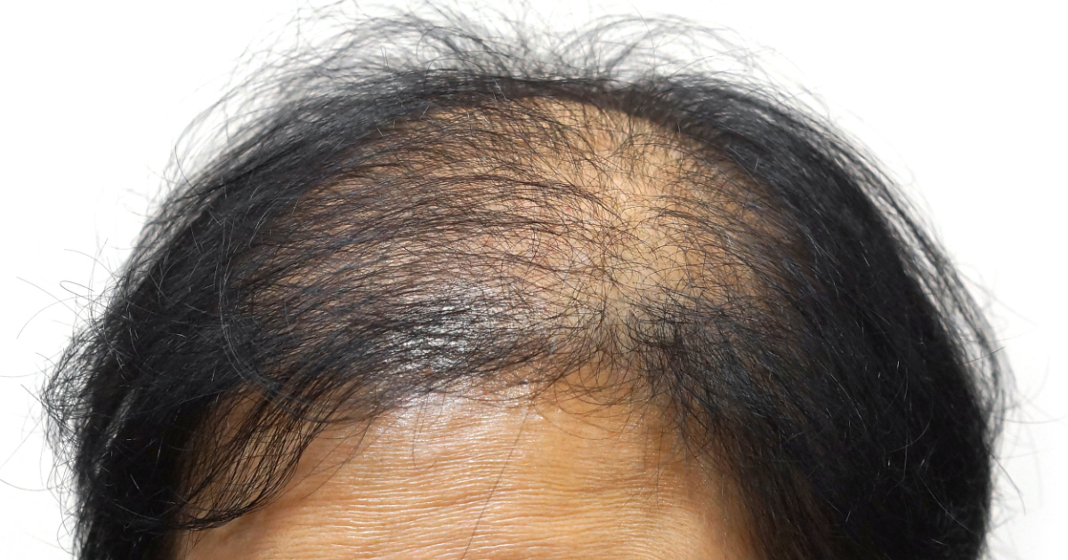 Alopecia femminile