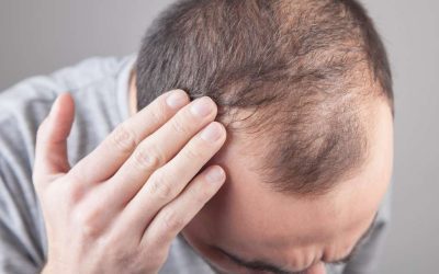 Perdita capelli cosa fare se la caduta è eccessiva