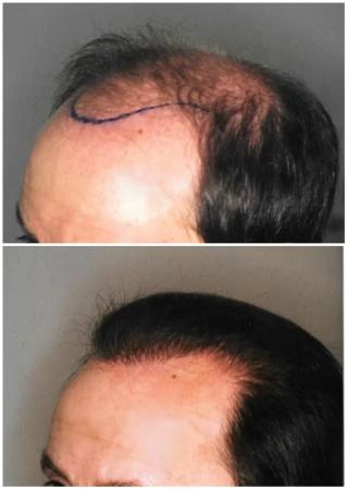 Autotrapianto capelli FUT Autotrapianto FUT