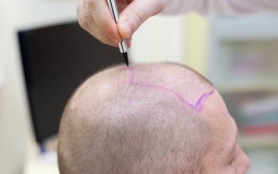 Trapianto con Tecniche Microfue Sapphire e DHI