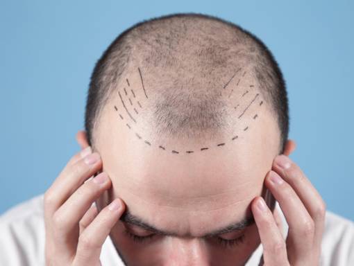 Trapianto capelli con tecnica FUT