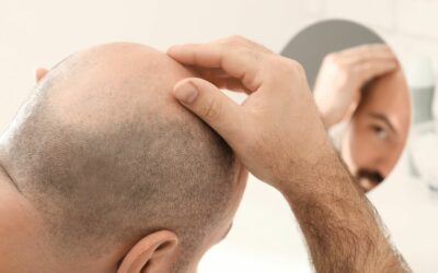 Trapianto capelli Turchia: convenienza ed innovazione ora disponibili in Italia