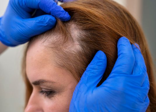 caduta capelli donne