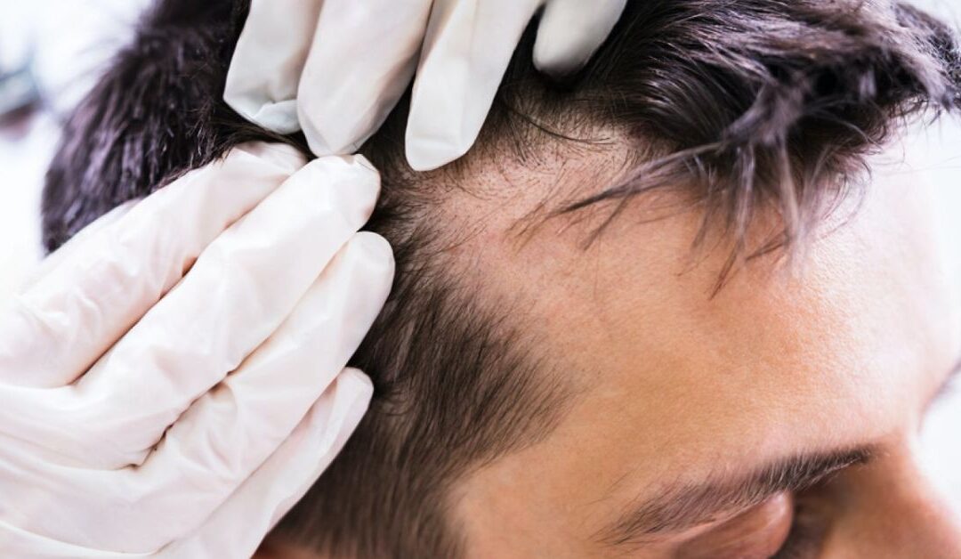 Caduta capelli quando preoccuparsi e come fermarla