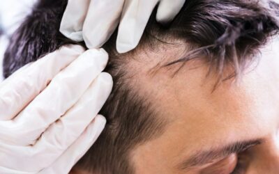Caduta capelli quando preoccuparsi e come fermarla