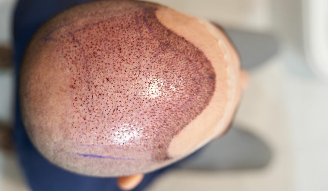 Costi del trapianto di capelli 2025: guida completa e prezzi aggiornati