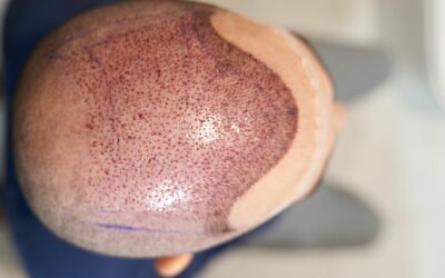 Costi del trapianto di capelli 2025: guida completa e prezzi aggiornati