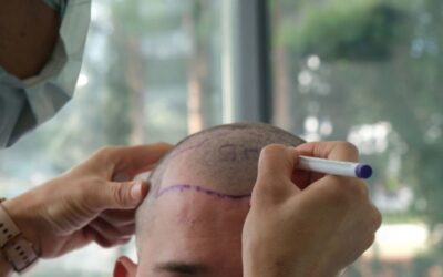 Trapianto di capelli in estate: si può fare?