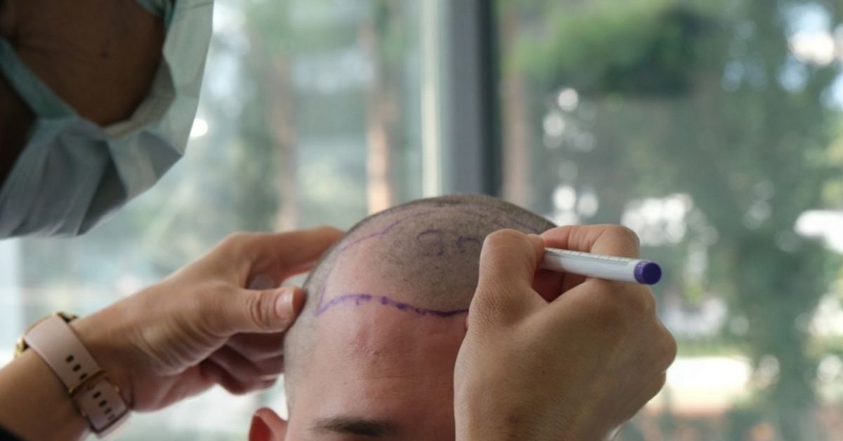 trapianto di capelli in estate