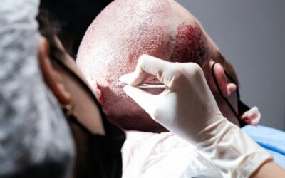 Quali sono i tempi di recupero di un trapianto di capelli? Tutti i risultati passo dopo passo