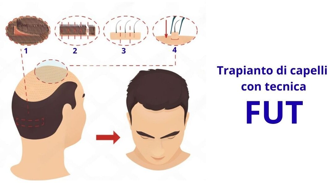 Come funziona il trapianto con tecnica FUT