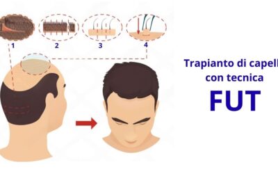 Come funziona il trapianto con tecnica FUT