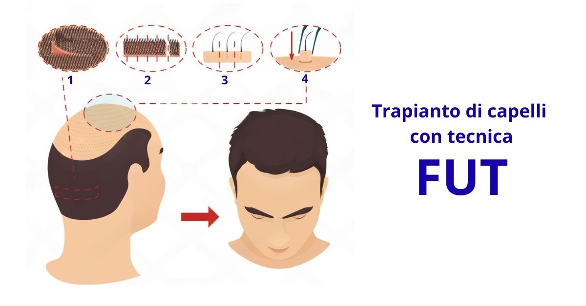 Trapianto Tecnica FUT