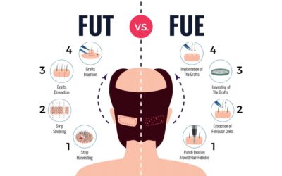 Trapianto capelli FUE e FUT: quali sono le differenze