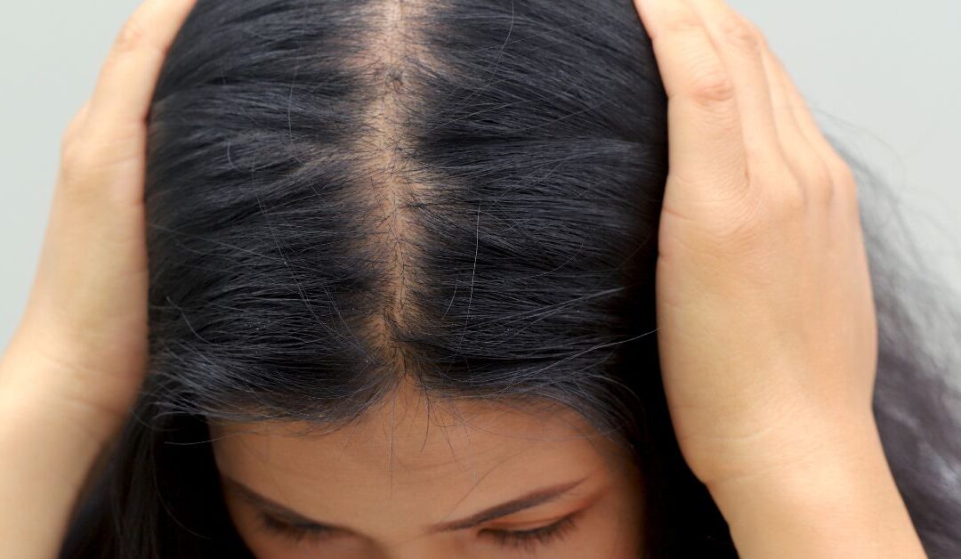 Cos’è la scala di Ludwig e come misura il diradamento dei capelli nella donna?