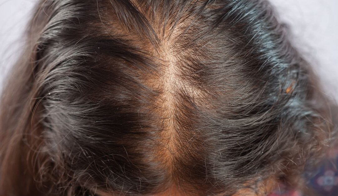 Cos’è la scala di Sinclair e come classifica il diradamento dei capelli nella donna?